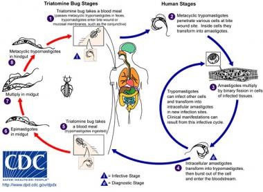 ملف:Chagas disease.jpg